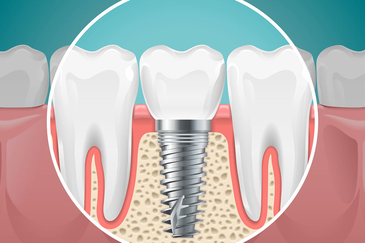 Dental Implant vs Bridge: What's Right For You?