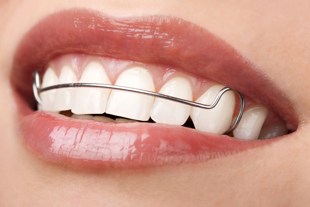Retainers After Clear Aligners: Why They Matter for Lifelong Results