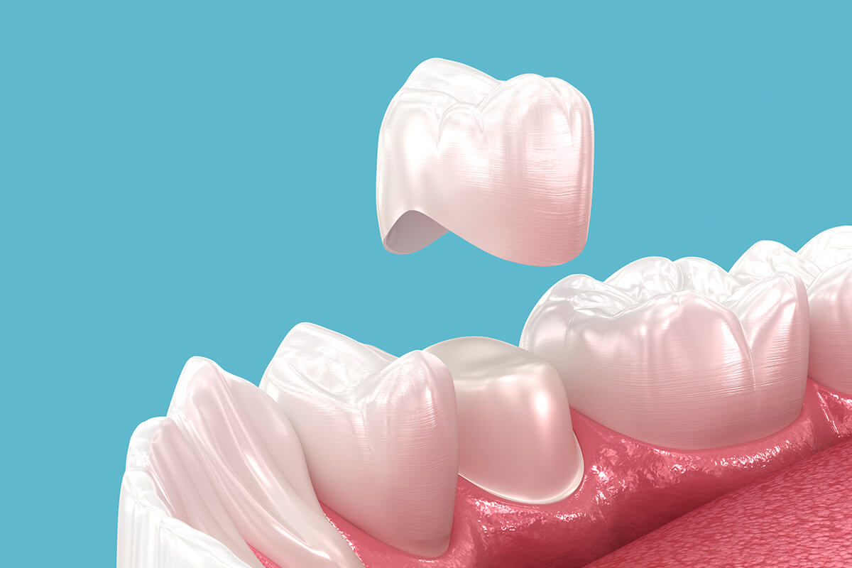 Saving Your Smile: How Much Tooth Is Needed for a Crown?