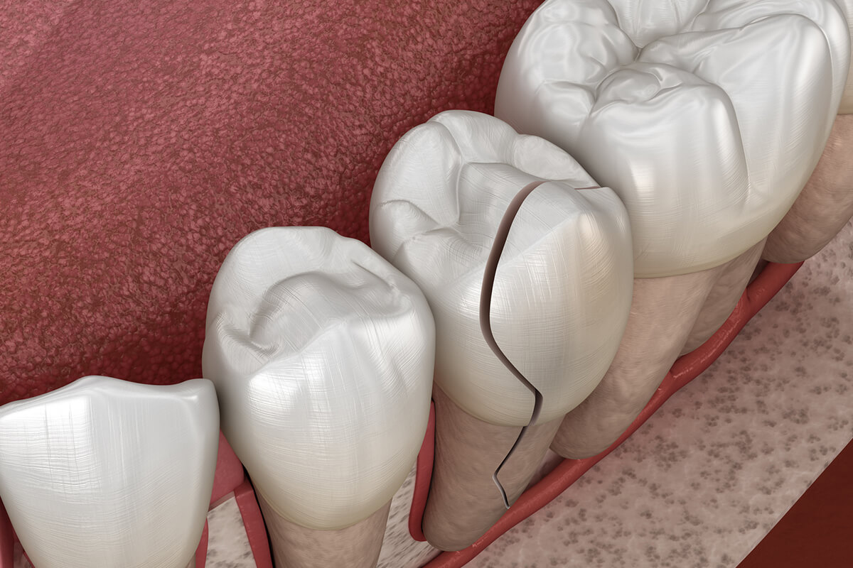 The Unspoken Signs of a Cracked Tooth